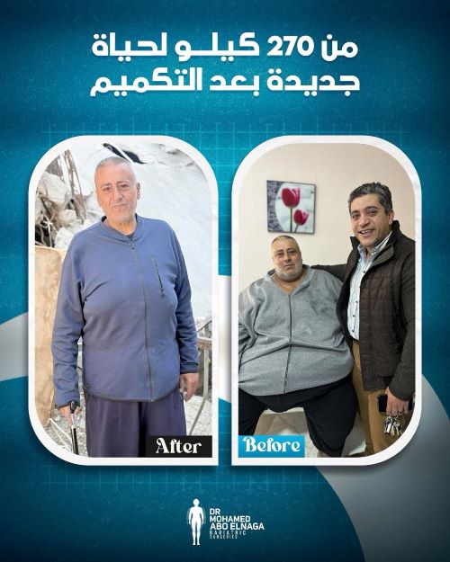 نصائح لزيادة نزول الوزن بعد التكميم